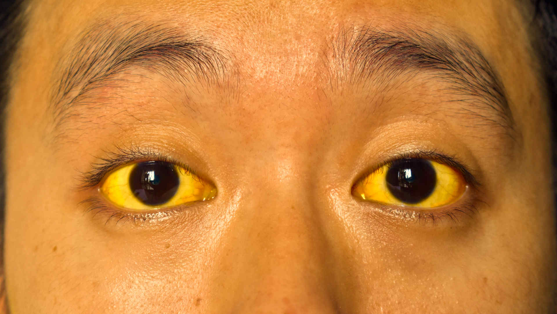 Scleral icterus