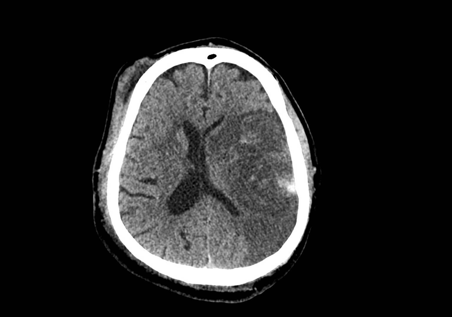 Large left hemispheric stroke on CT