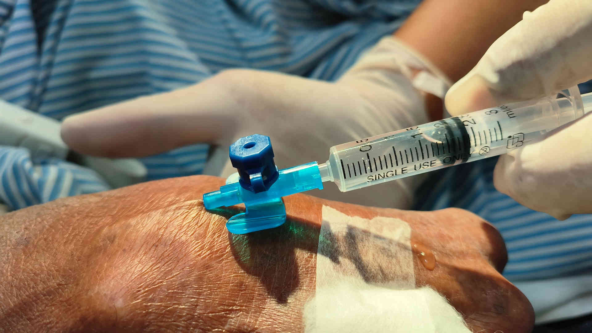 Peripheral intra venous callula being flushed