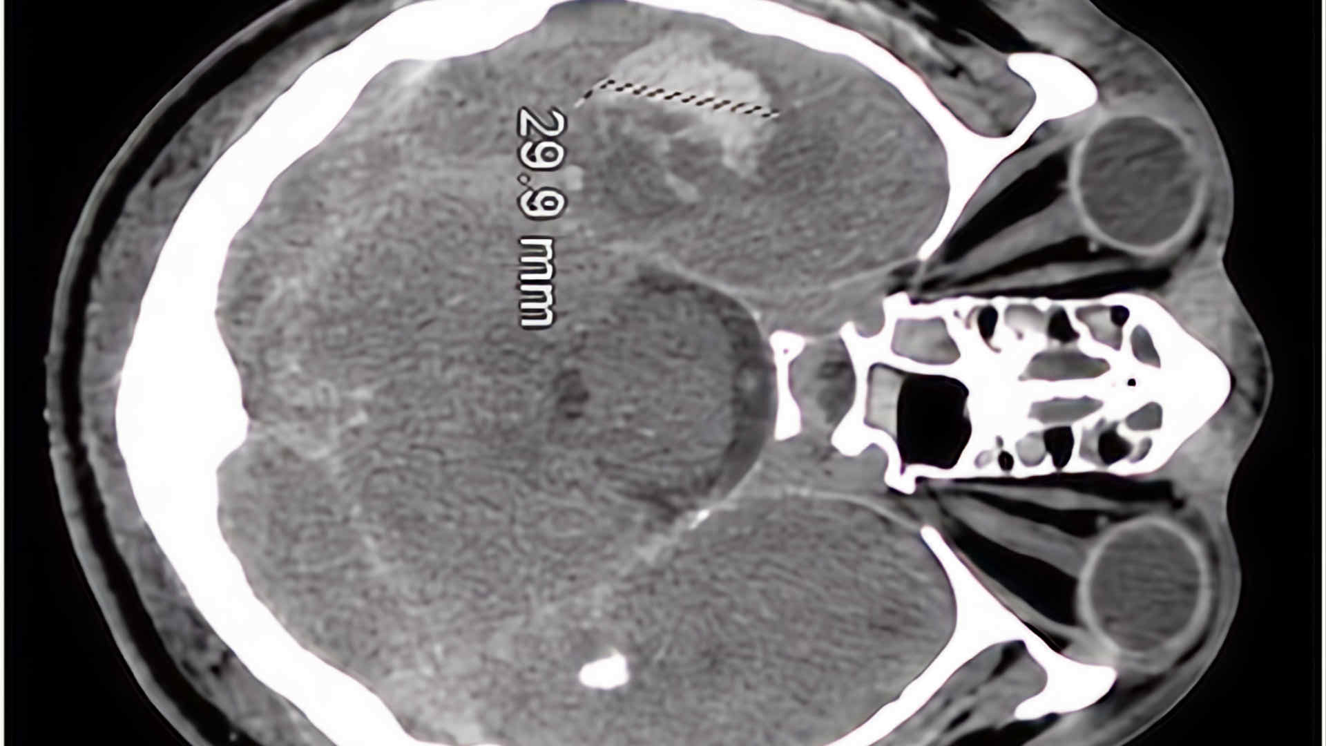 Traumatic subarachnoid haemorrhage with cerebral oedema