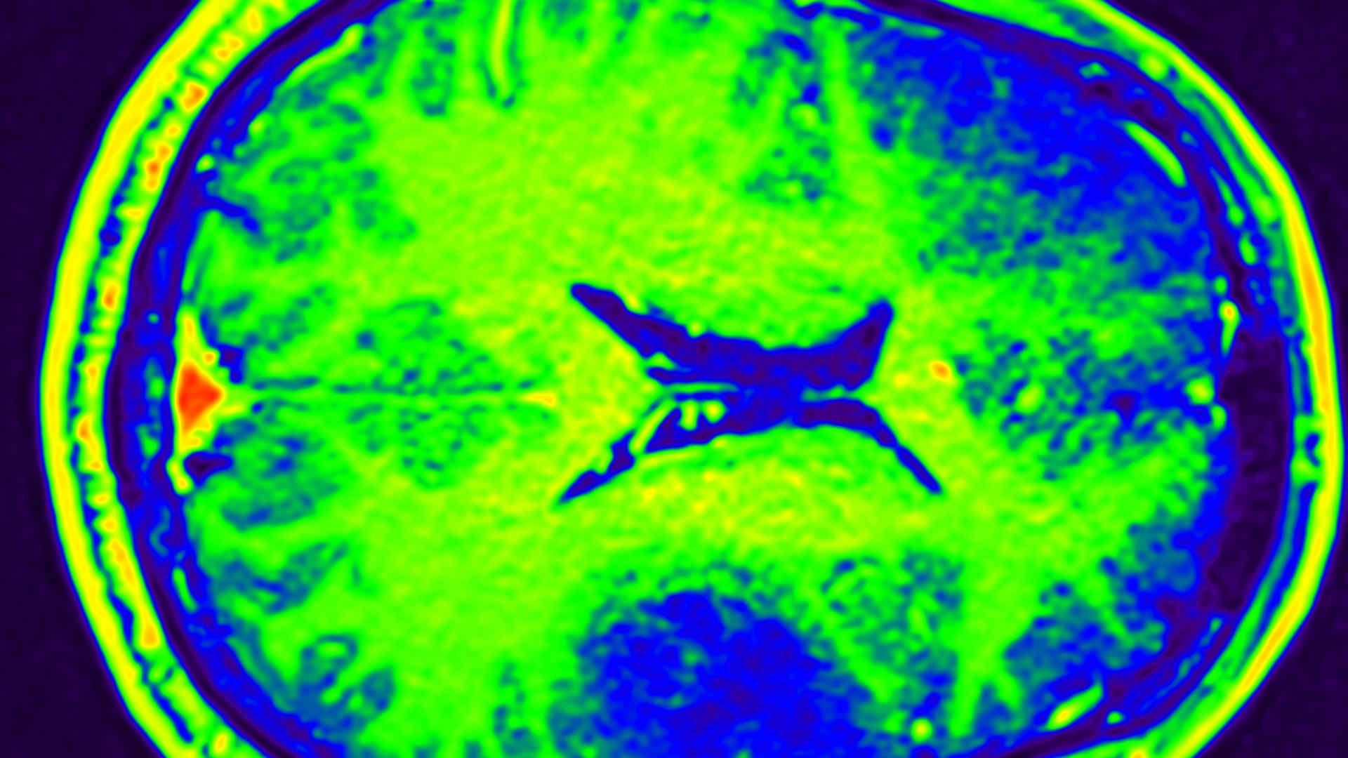 Brain MRI