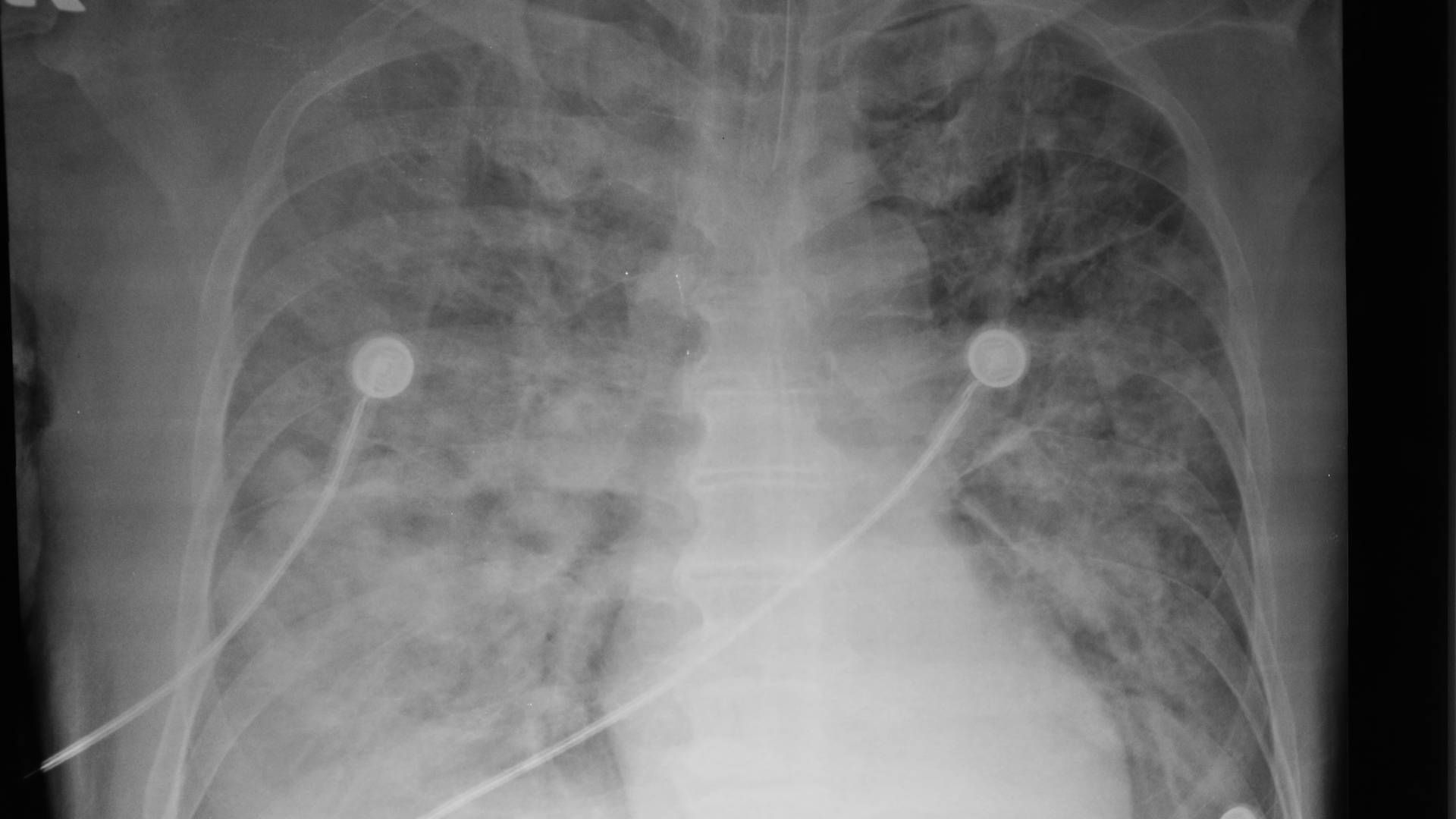 Radiograph consistent with ARDS