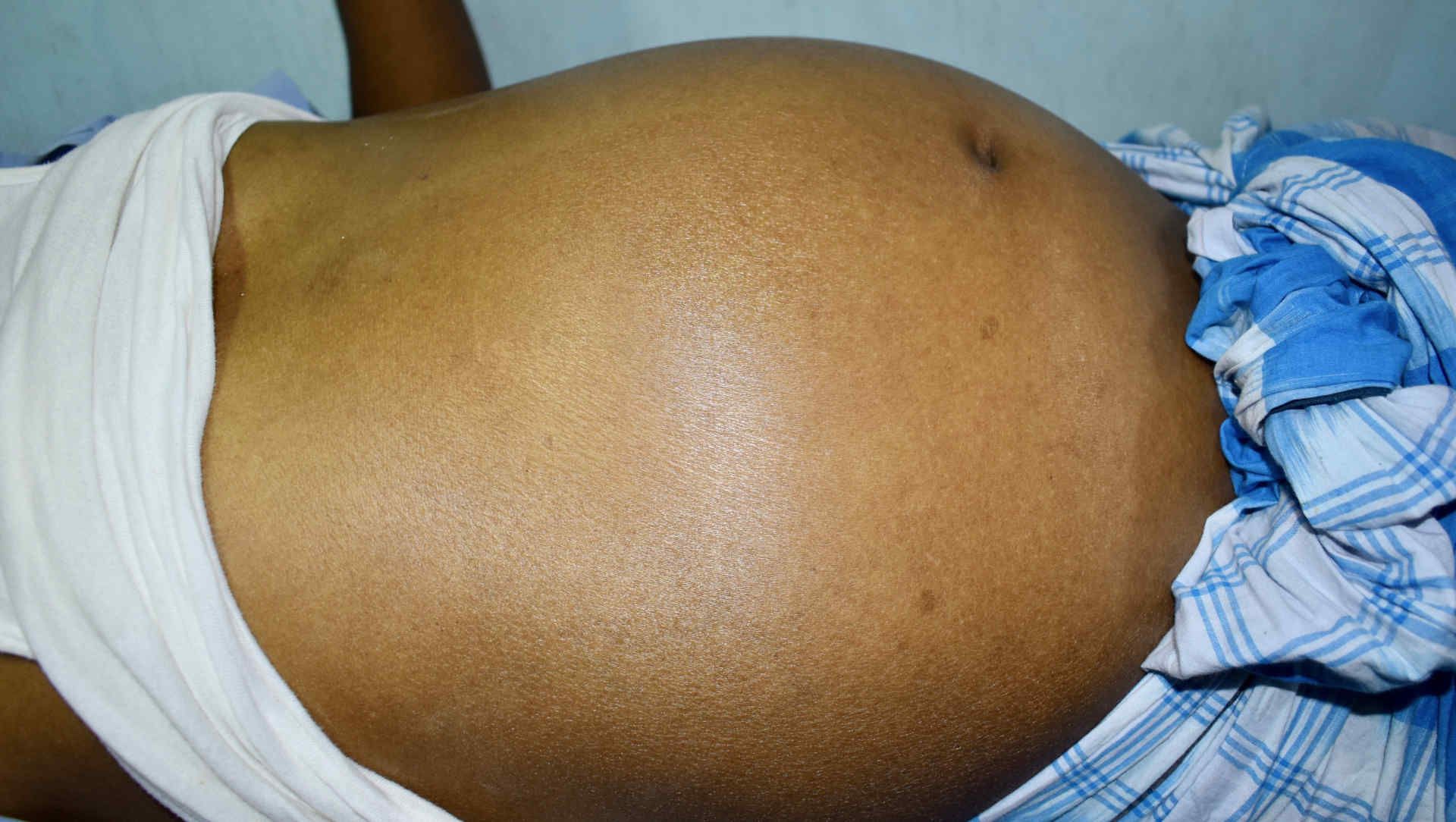 CXR of a lobar pneumonia