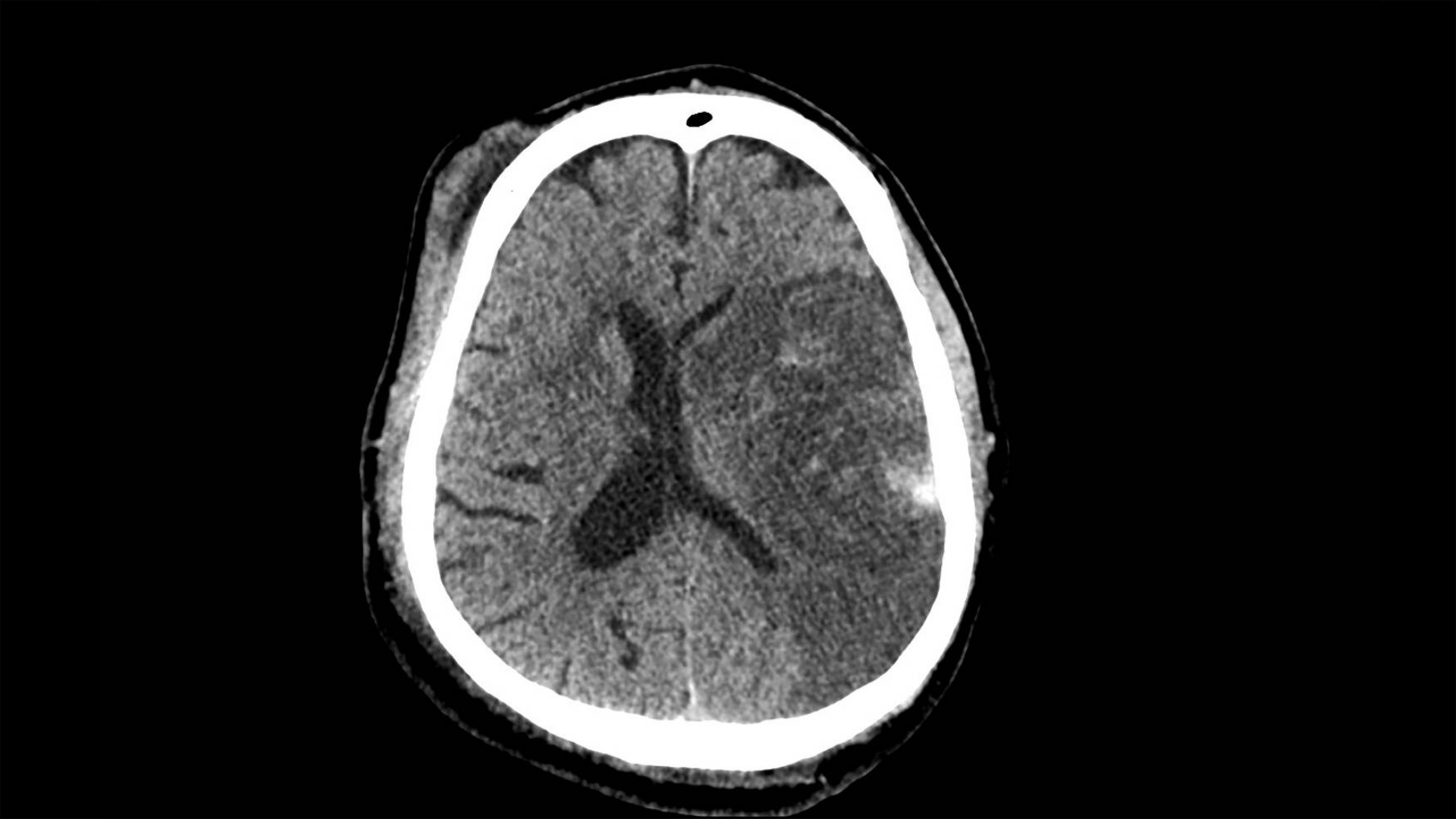 CT scan large left cerebral infarct with mass effect and haemorhage