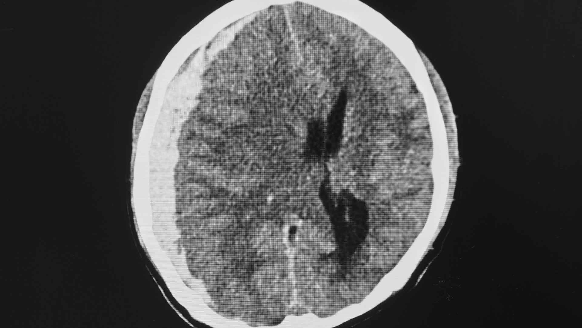 CT subdural haematoma