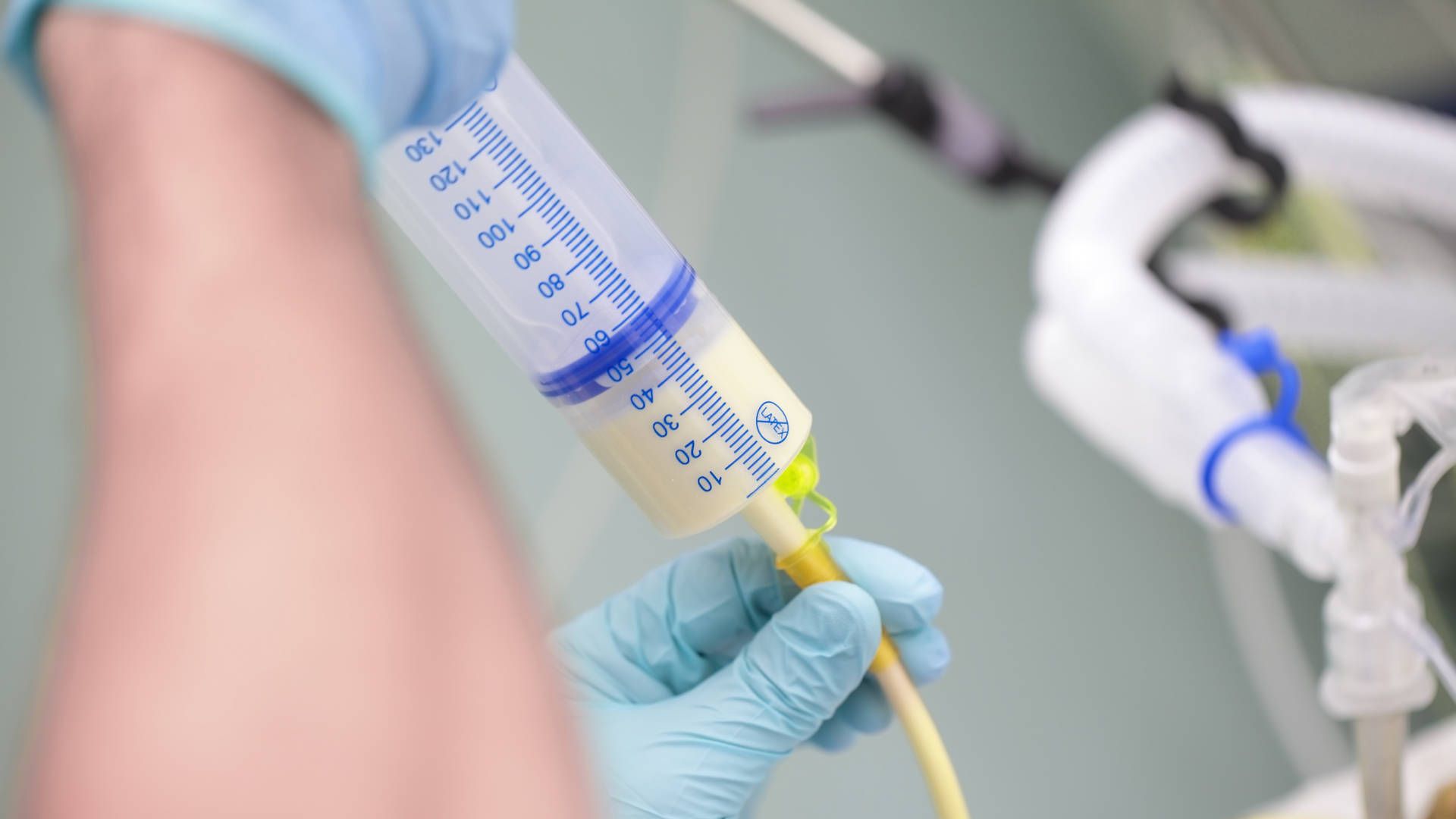 Patient being fed via an NG tube