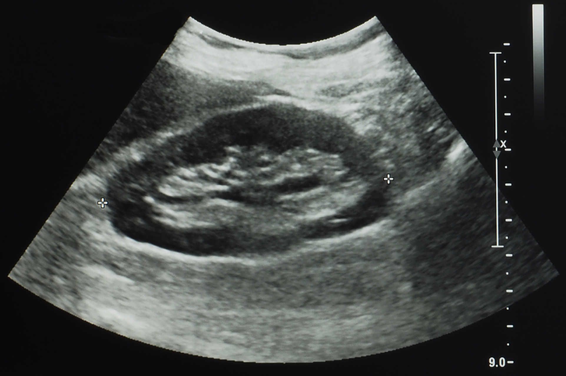 Ultrasound scan of a kidney