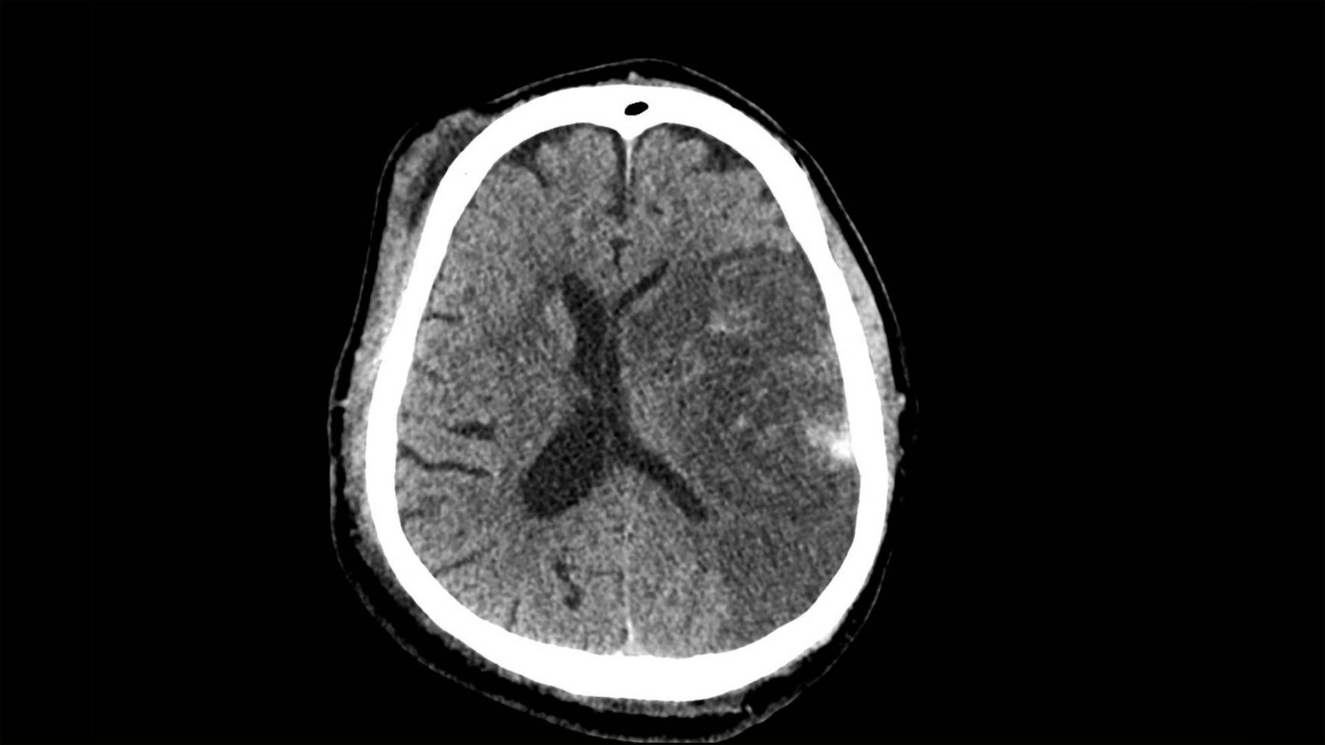 CT brain showing a large left sided infarction with mass effect