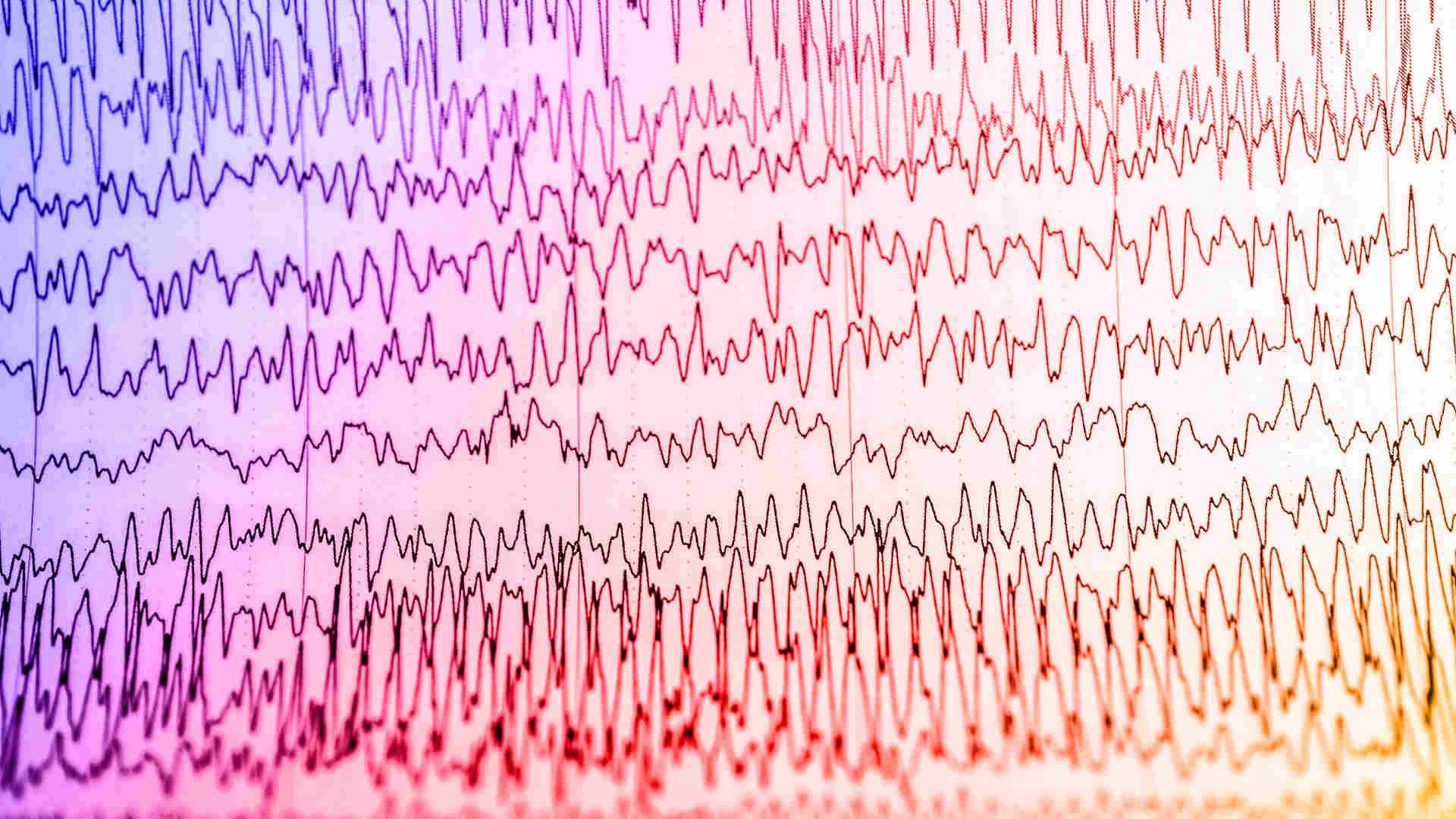 EEG showing status epilepticus