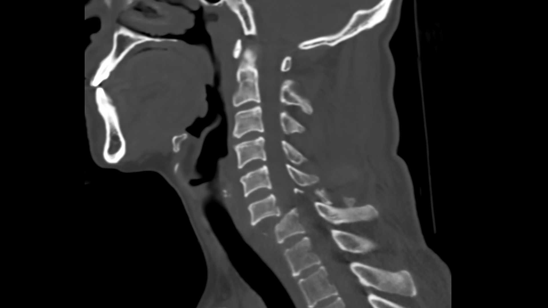 Cervical spinal cord injury