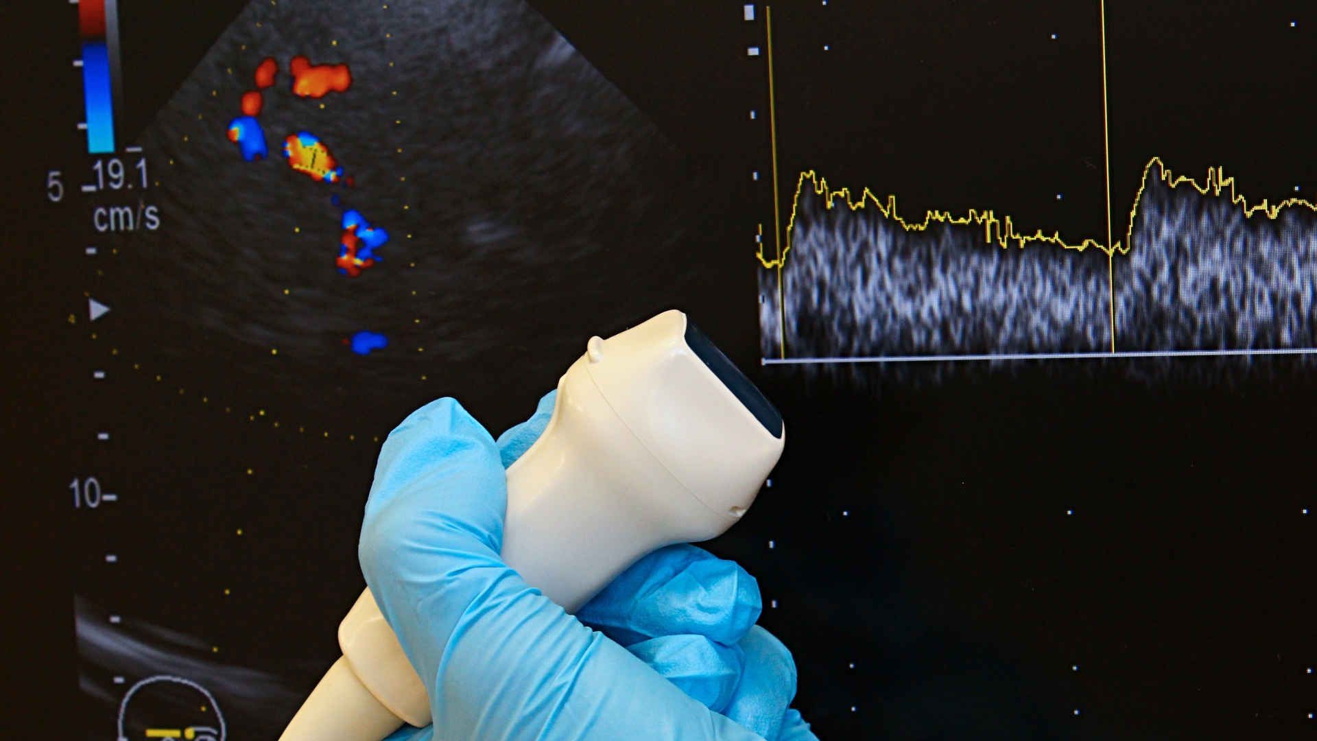 Transcranial doppler ultrasound