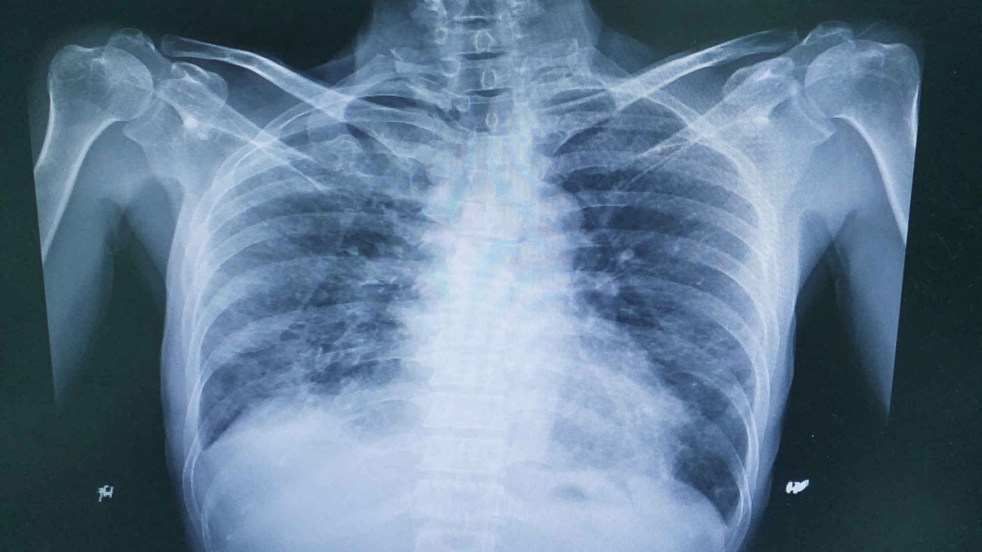 Chest radiograph showing interstitial lung disease