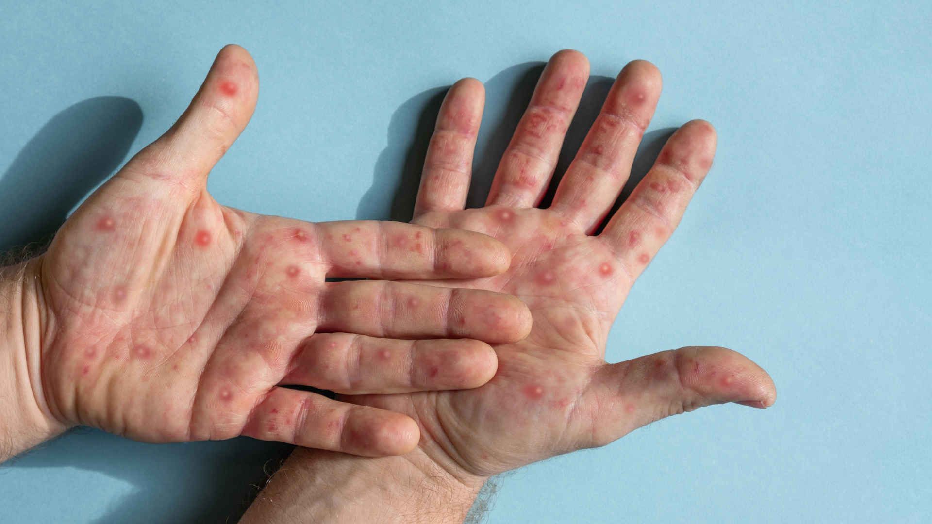 Mpox lesions on hands