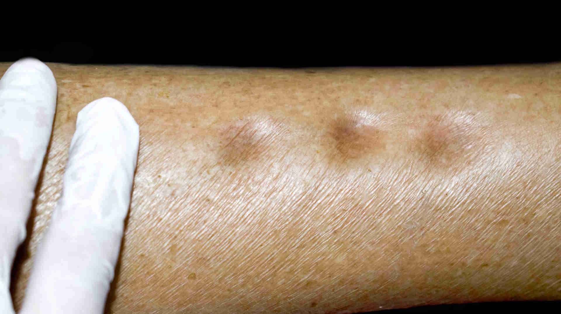 Finger imprints in a patient with pitting oedema